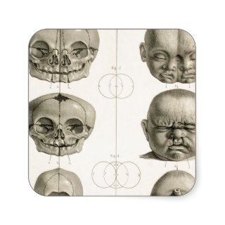 Infant Skull Deformities Weird/Conjoin Baby Square Sticker
