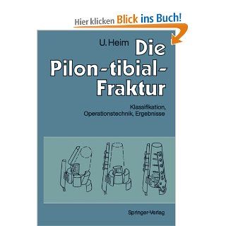 Die Pilon tibial Fraktur: Klassifikation, Operationstechnik, Ergebnisse German Edition: Urs Heim: Bücher